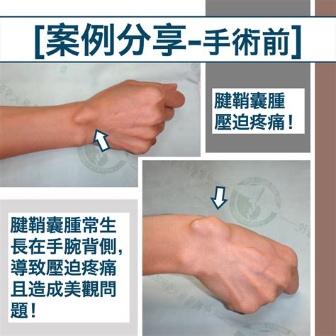 劍鞘腫|腱鞘囊腫 Ganglion Cyst｜手腕疾病專欄｜手外科醫